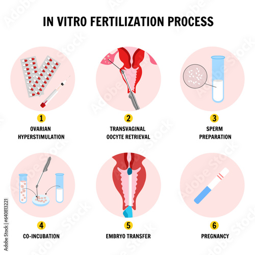 In vitro fertilization process IVF infographics and illustrations with steps 