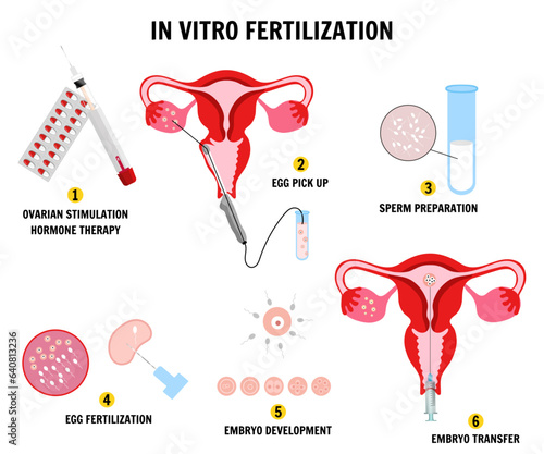 In vitro fertilization IVF infographics and illustrations with steps 