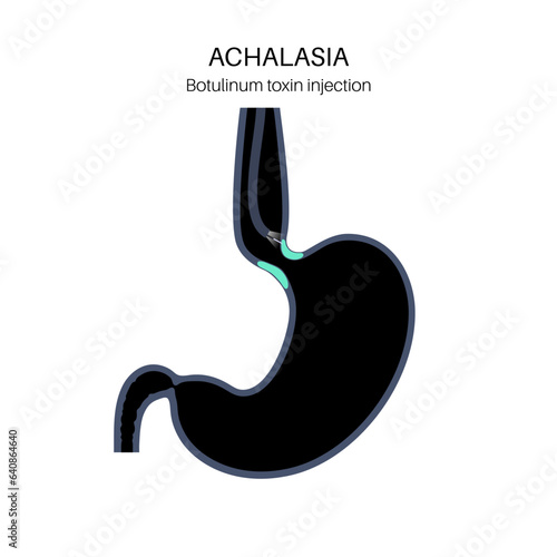 esophageal botulinum toxin injection