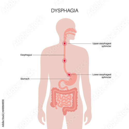 Dysphagia medical poster
