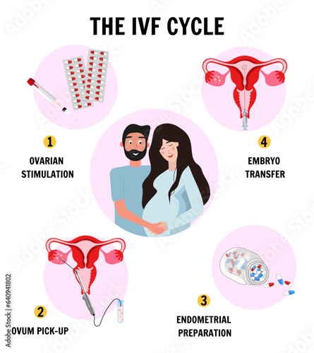 In vitro fertilization IVF infographics and illustrations with steps 