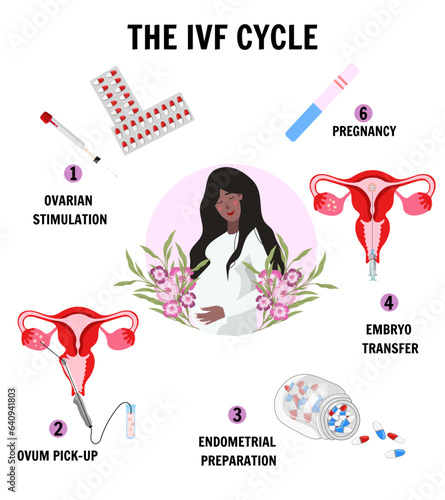 In vitro fertilization IVF infographics and illustrations with steps 