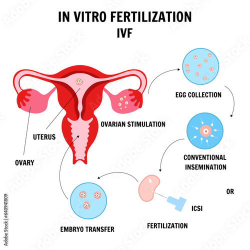 In vitro fertilization IVF flat infographics and illustration with steps of additional techniques