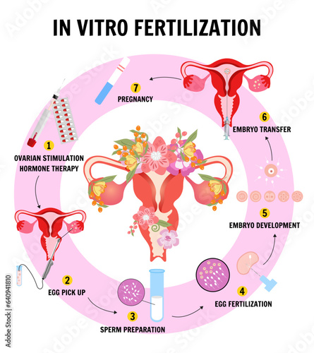 In vitro fertilization IVF flat infographics and illustration with steps of additional techniques