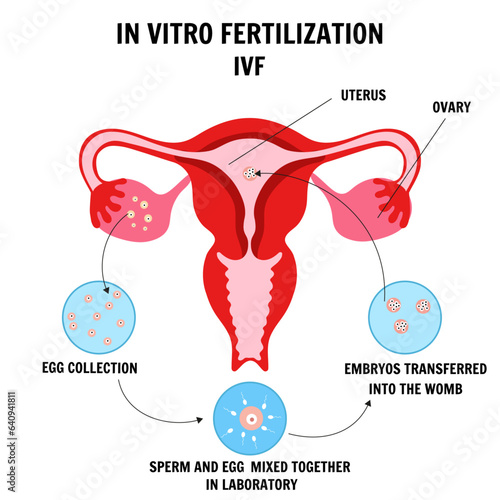 In vitro fertilization IVF flat infographics and illustrations with steps of additional techniques