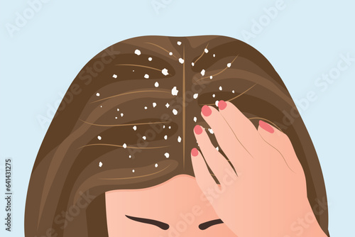 woman with dandruff on the hair- vector illustration