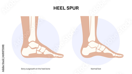 Heel spur poster photo