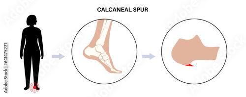 Heel spur poster