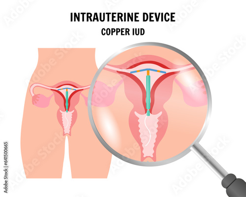 IUD intrauterine device copper iud
