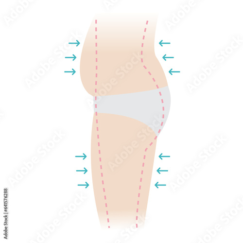 Side of the woman fat belly, hip and thigh with arrows, dotted lines marks vector illustration isolated on white background. Overweight, liposuction, cellulite removal, skin lifting concept.