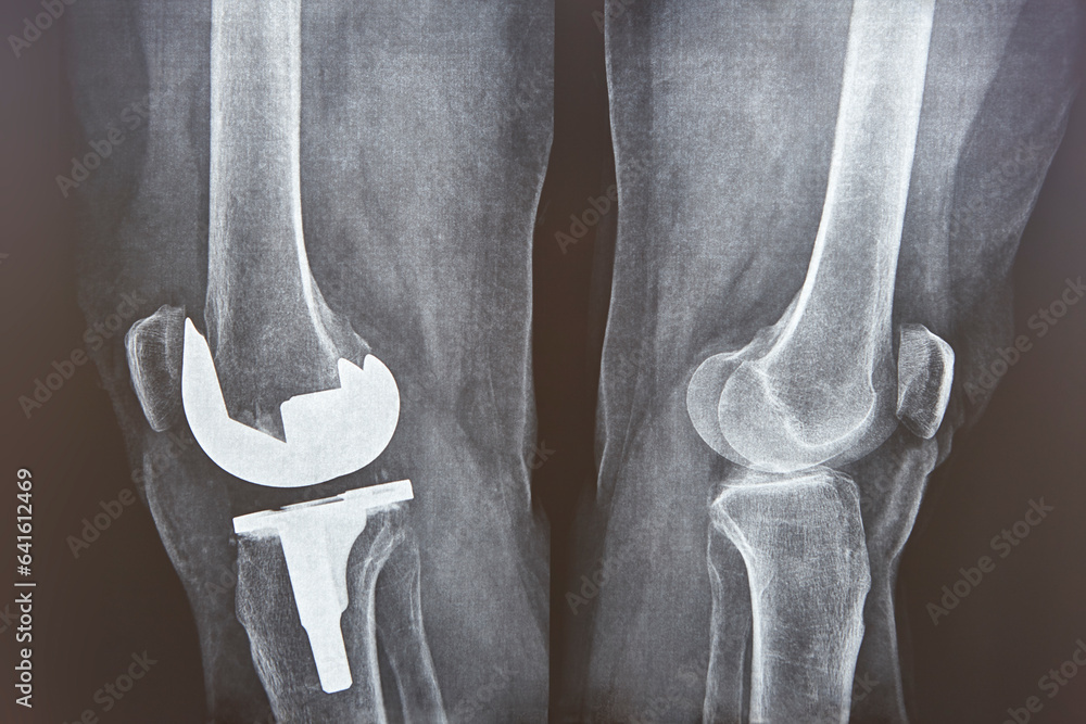Knee cap replacement xrays. Titanium implant. Osteoarthritis. Anatomy Stock Photo Adobe Stock