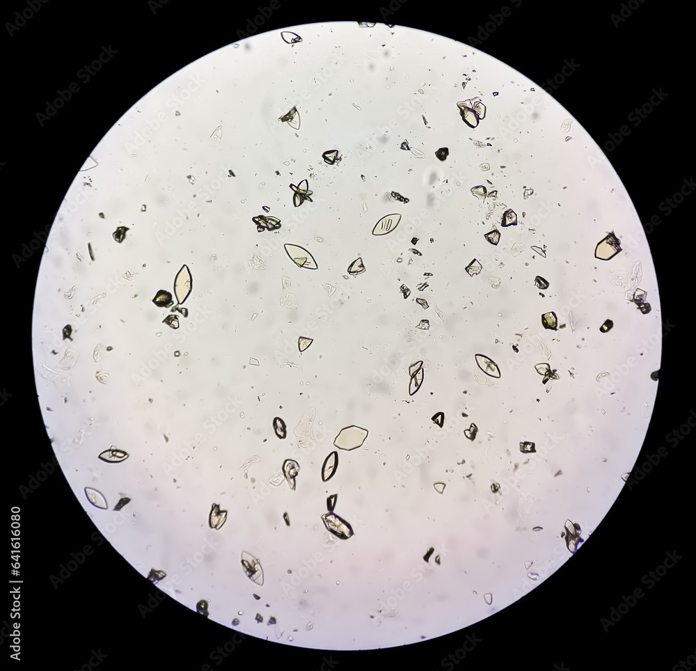 Photomicrograph of Uric acid crystal in urine sediment Stock Photo ...