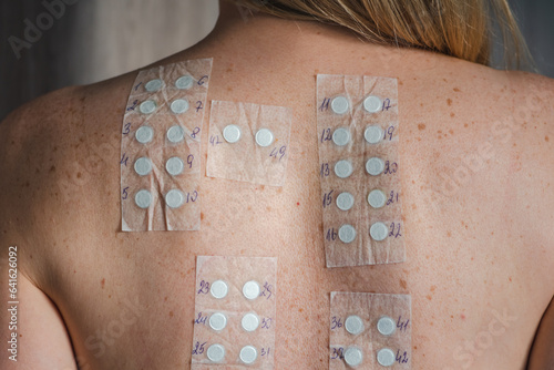 Patch test on the naked shoulder and back of a blonde hair young girl. Allergy patch testing is used to screen substances to determine the cause of an allergic skin reaction