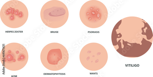 Different types of psoriasis vector set. Part of patients skin with dermatitis, inflammation, red rash and other skin problems vector illustration suitable for women's skin health problems