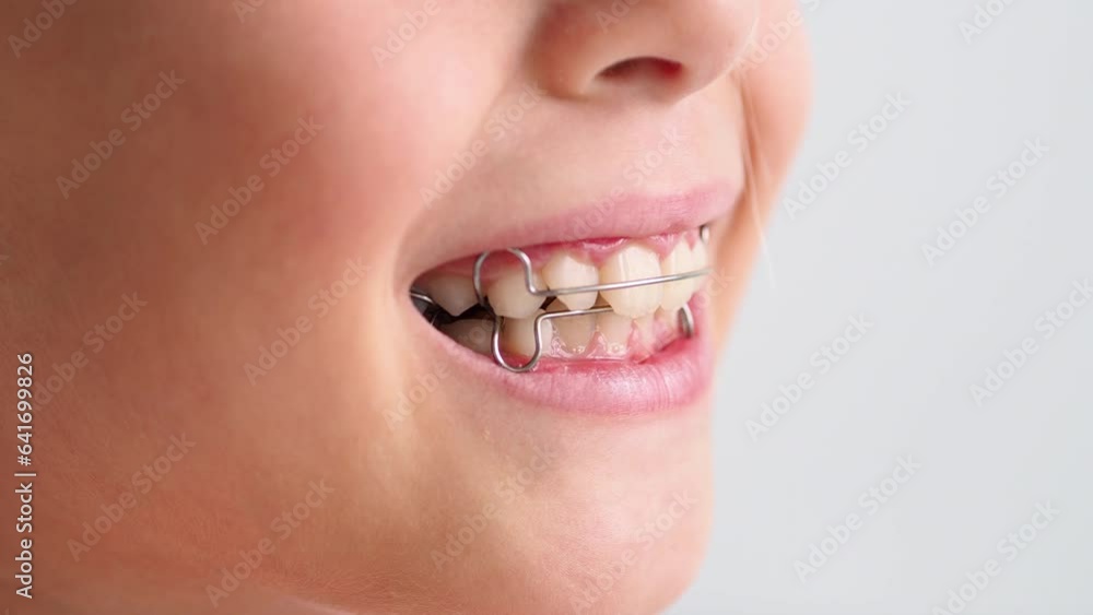 Video Stock Children's teeth are large, with a dental plate. Bracket