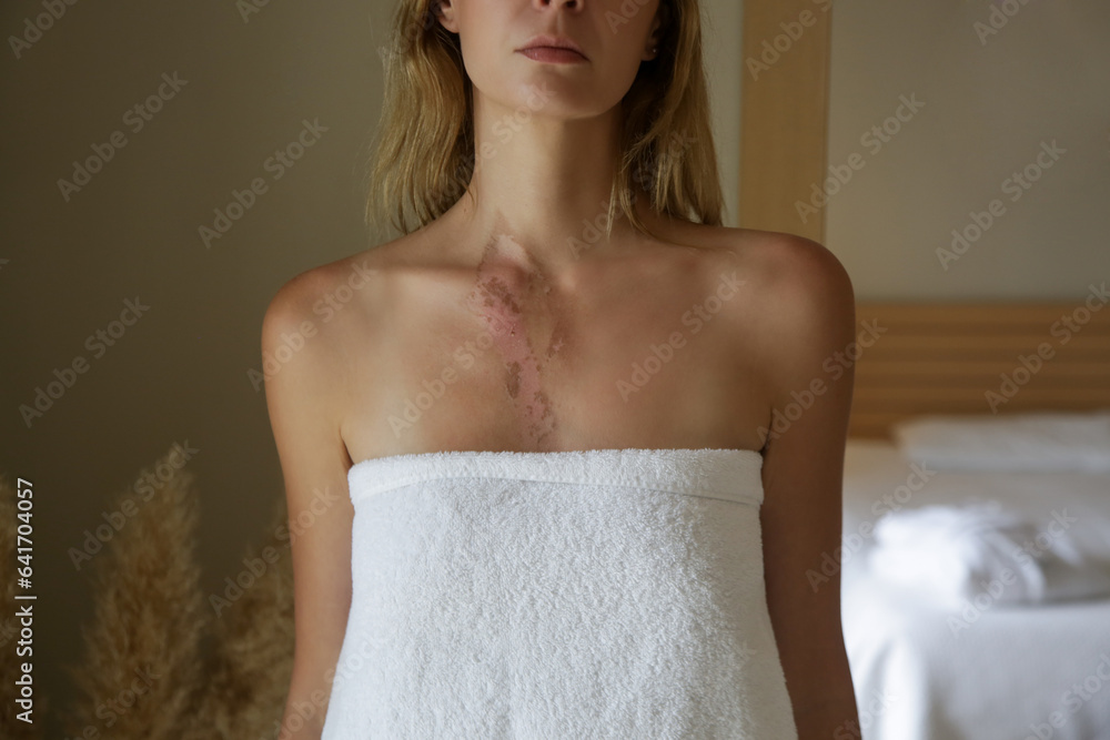 A second-degree burn with peeling skin on woman's chest