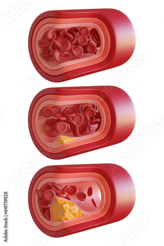 3D Rendering Artery Atherosclerosis Cut Three Step transparent