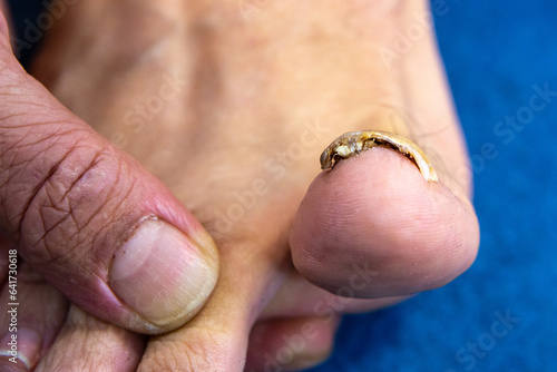 Photography Toe nail with onychomycosis bottom view
