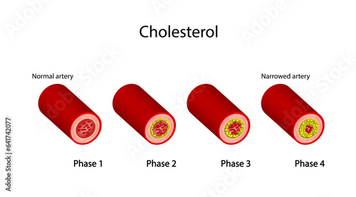 Atherosclerosis, normal artery versus narrowed artery blocked with cholesterol plaque. Blood vessel blocked with a clot. High cholesterol level as atherosclerotic risk. Vector illustration. photo