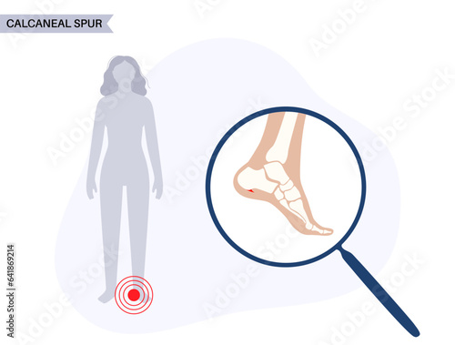 Heel spur poster