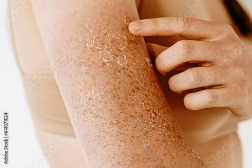Peeling skin with freckles after sunburn  dermatological problems on female arms and shoulders  skin care concept  sensitive skin . The girl applies a moisturizing cream to the burnt and peeling skin.