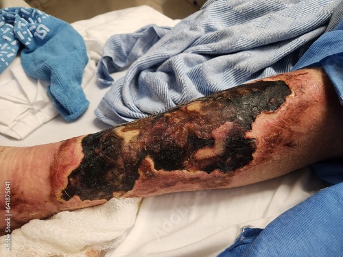 Superficial leg skin necrosis with ulcerations - gangrenous tissues photo