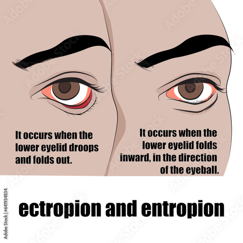 Entropion is a condition in which the eyelid folds inwards, ectropion is the eyelid folds outwards.