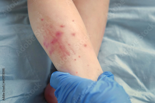 Doctor hands examining infant leg. Little Kid allergy. Closeup. Child scratches a red rash. Nurse applies a special cream to atopic skin. Dermatitis, diathesis, irritation on the baby body. Pruritus