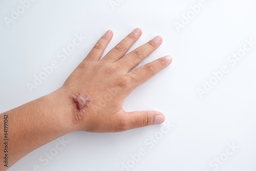 Hypertrophic Keloid scar on hand back of young woman on white background  imperfections skin concept