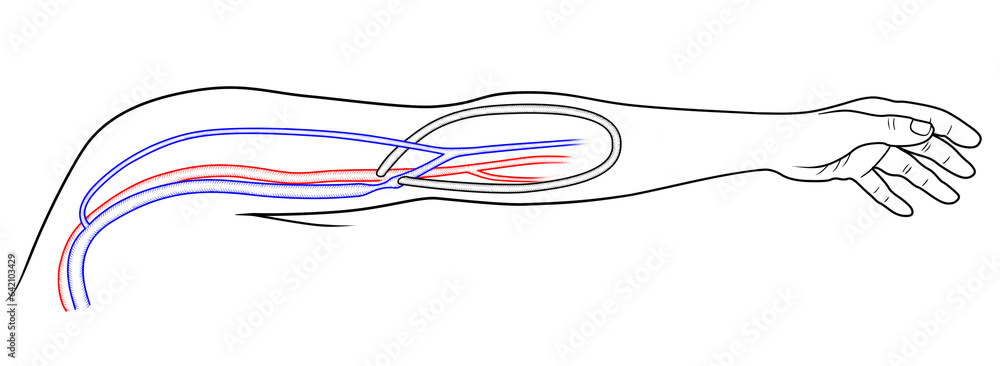 Fototapeta premium Arteriovenous loop graft with graft-venous junction stenosis