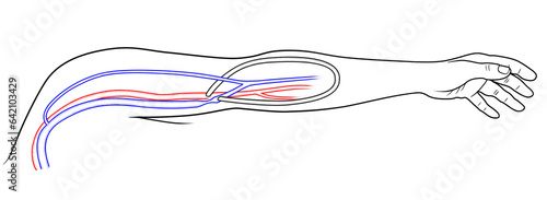 Photos Arteriovenous loop graft with graft-venous junction stenosis