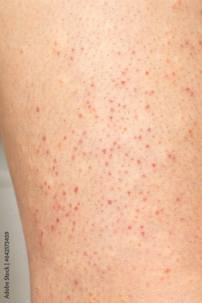 Macro of female skin with folliculitis Macro of female skin with folliculitis