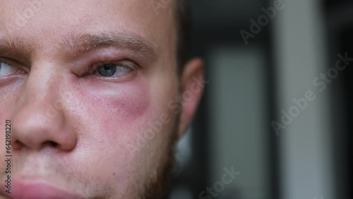 inflammation of the eye conjunctivitis, an allergic reaction in a man