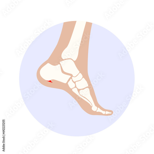 Heel spur icon