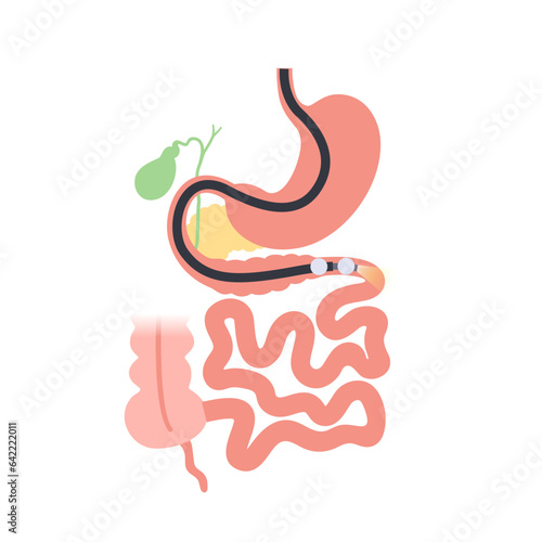 Double balloon enteroscopy