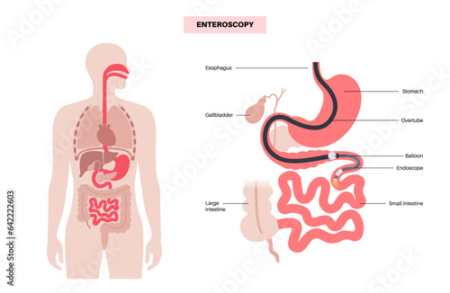Double balloon enteroscopy