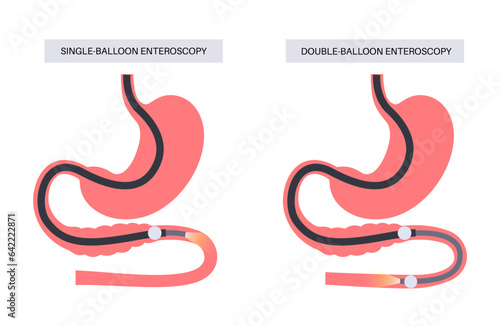 Balloon assisted enteroscopy