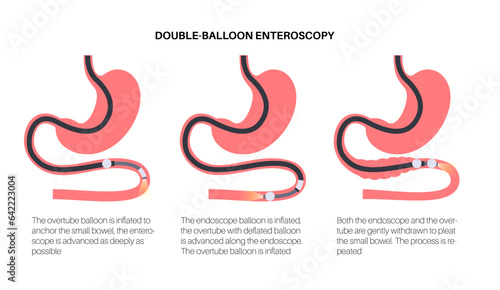 Double balloon enteroscopy