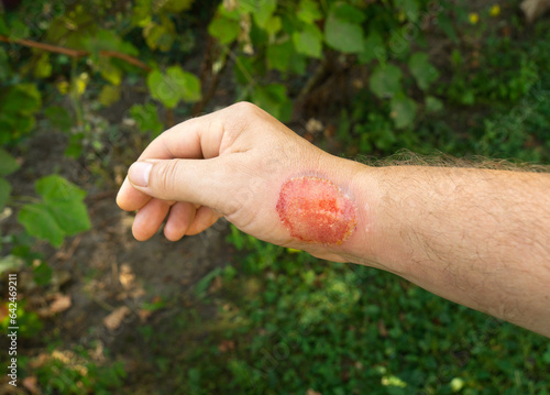 A second degree burn on a man's hand. Large red wound on the arm. © Виталий Борковский