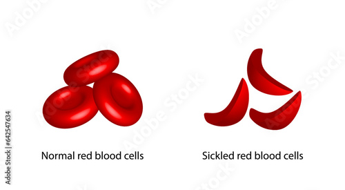 Sickle cell anemia, disease. Normal red blood cell and sickle cell, isolated on white background. Gene mutation. Vector illustration.