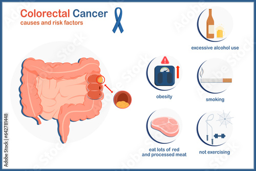 medical vector illustration Causes and risk factors that cause colon cancer.Obesity,drinking alcohol,not exercising,eating red and processed meat and smoking.flat style isolated on white background.