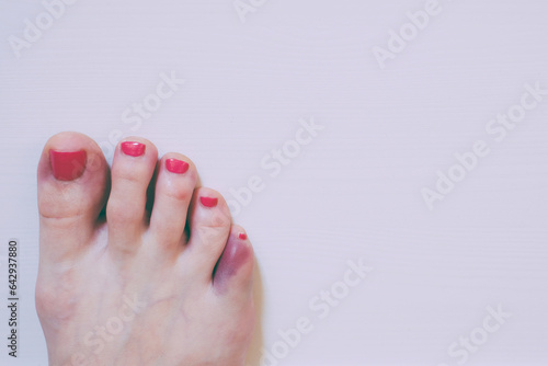 Foot with broken pinky toe caused by forceful impact with furniture. Baby toe fracture and hematoma. Copy space for text. photo