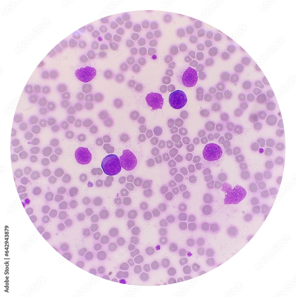 Smudge cells, Gumprecht shadows, smear cells, or basket cells, are a