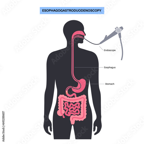 esophagogastroduodenoscopy medical procedure