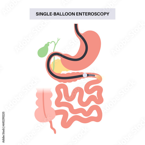 Single balloon enteroscopy