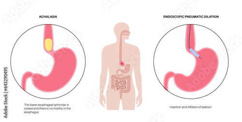 Endoscopic pneumatic dilation