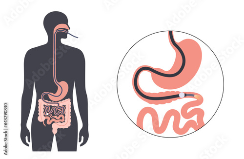 Single balloon enteroscopy