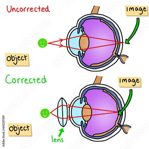 Corrected Vs Uncorrected Vision Short Sighted Science Illustration Drawing Educational photo