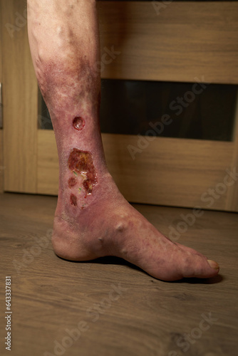 Close-up of a wound on a patient's leg