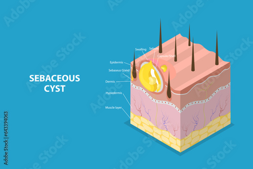 3D Isometric Flat Vector Conceptual Illustration of Sebaceous Cyst photo